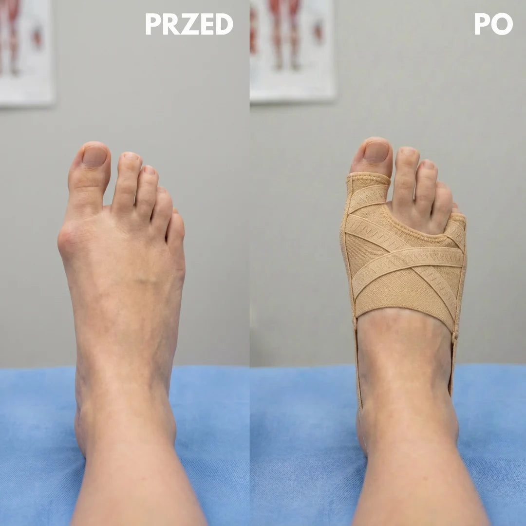 AuraStep™ - Korektor Haluksów